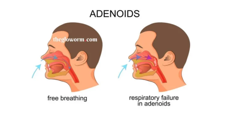 adenoidid